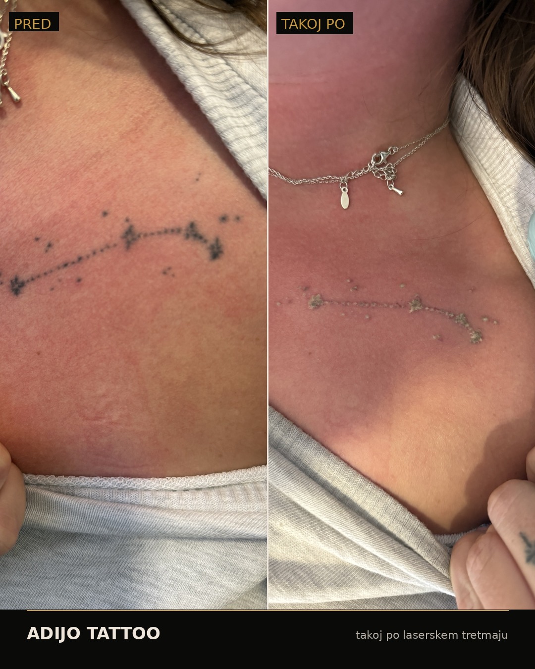 Odstranjevanje tetovaž – Adijo Tattoo 7 rezultat po prvem tretmaju odstranjevanje tatujev Maribor