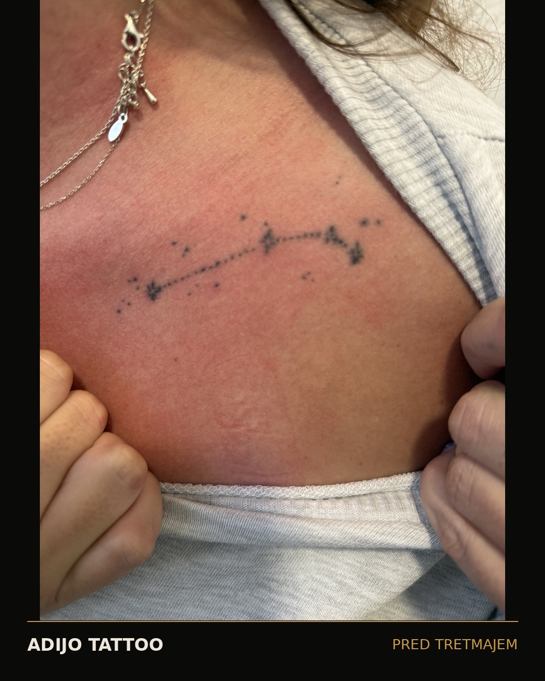Odstranjevanje tetovaž – Adijo Tattoo 5 odstranjevanje tetovaž takoj po laserskem tretmaju