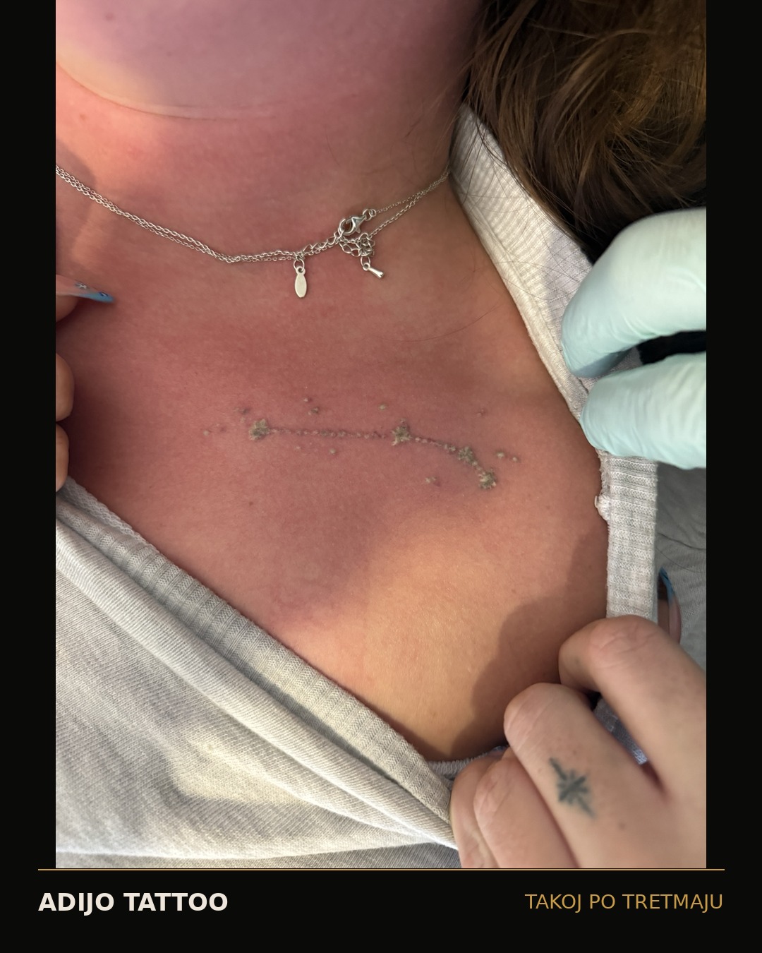 Odstranjevanje tetovaž – Adijo Tattoo 6 majhen linework tattoo pred laserskim odstranjevanjem