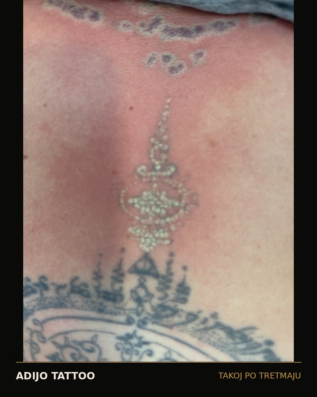 Odstranjevanje tetovaž – Adijo Tattoo 9 večji črni ornament takoj po laserskem tretmaju