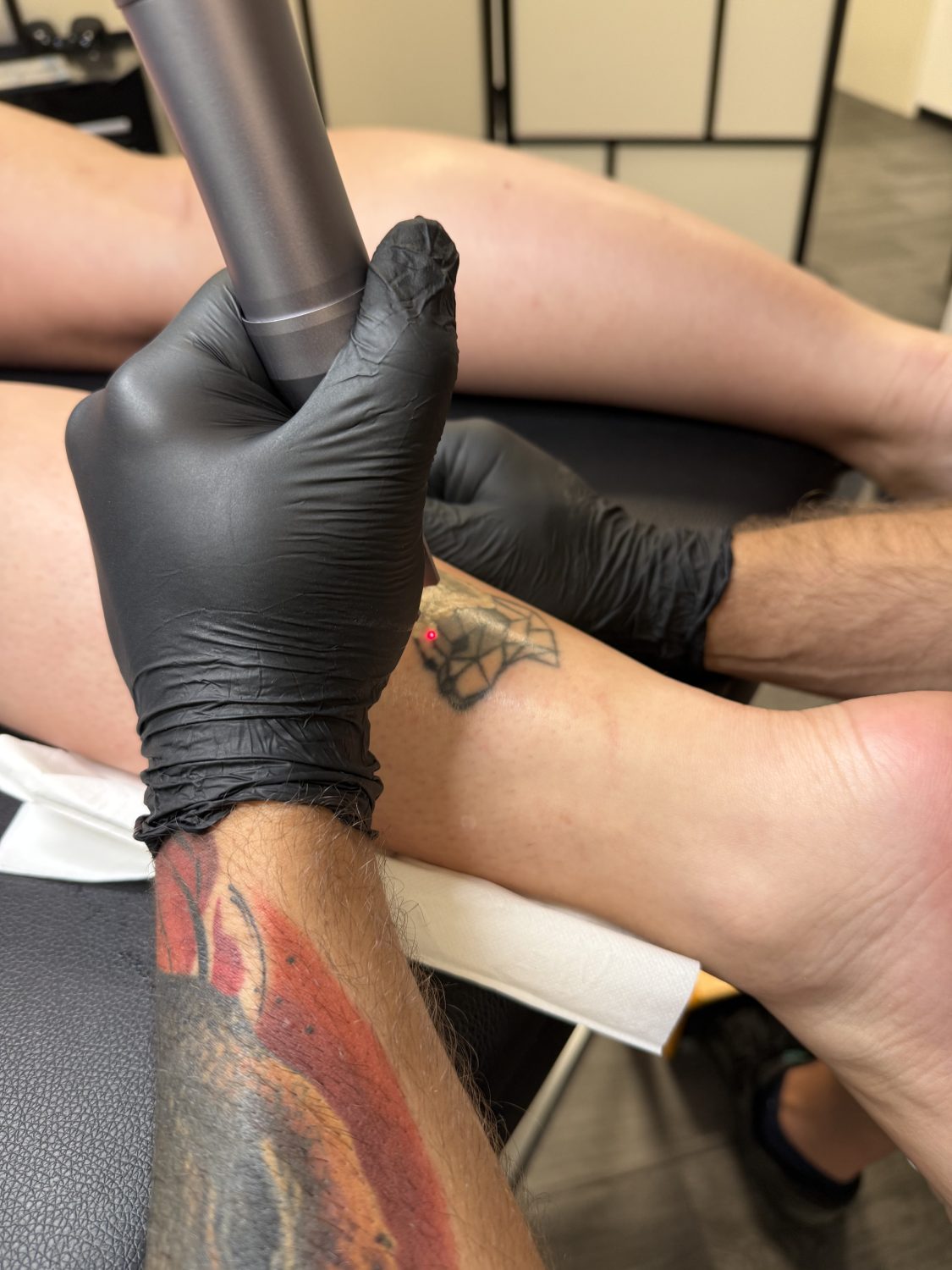 Odstranjevanje tetovaž – Adijo Tattoo 3 lasersko odstranjevanje tatujev med tretmajem Maribor